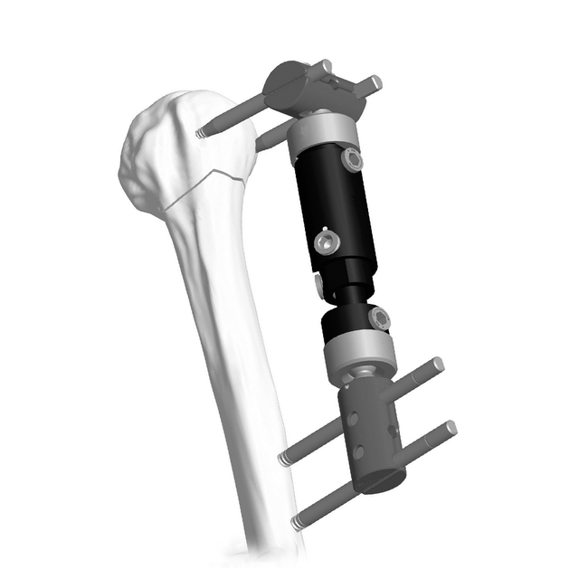 Lower Limb Micromotion External Fixator (T-type) - Paediatric