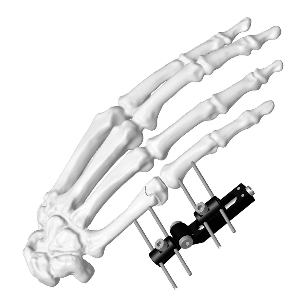 Mini External Fixator (Horizontal axis)