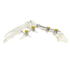 Wrist External Fixator (Integrated)