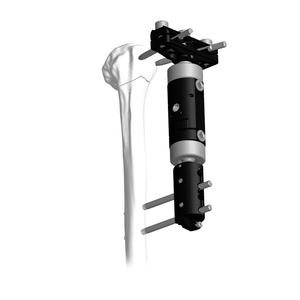 Lower Limb Micromotion External Fixator (T-type)