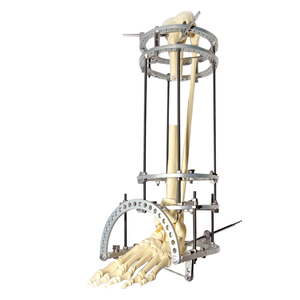 Tibia Transport Ilizarov Fixator