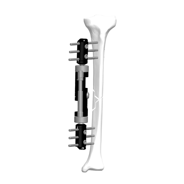 Lower Limb Micromotion External Fixator (Straight-type)