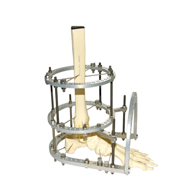 Ankle Traction Ilizarov Fixator