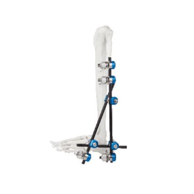 Ankle External Fixator