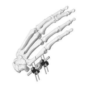 Mini External Fixator (Straight-type)