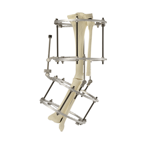 Ankle Traction Ilizarov Fixator