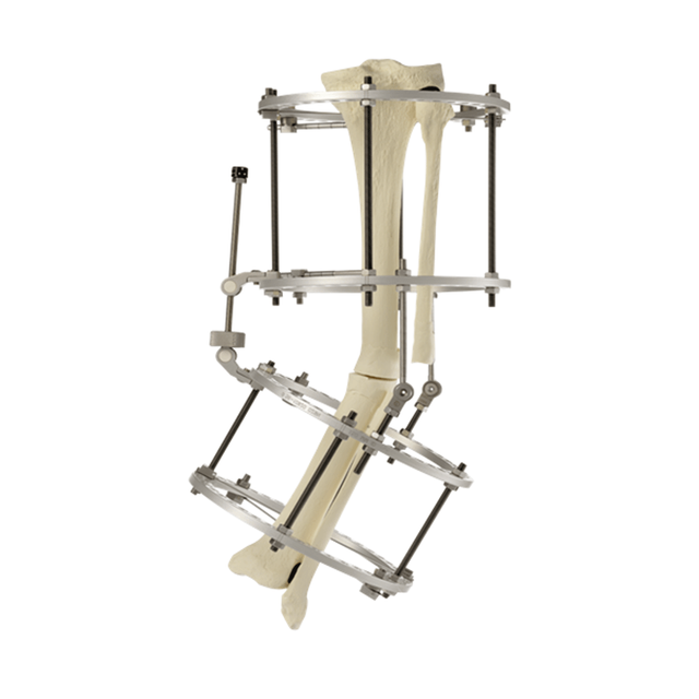 Ankle Traction Ilizarov Fixator