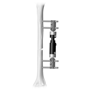 Lower Limb Micromotion External Fixator (Straight-type)