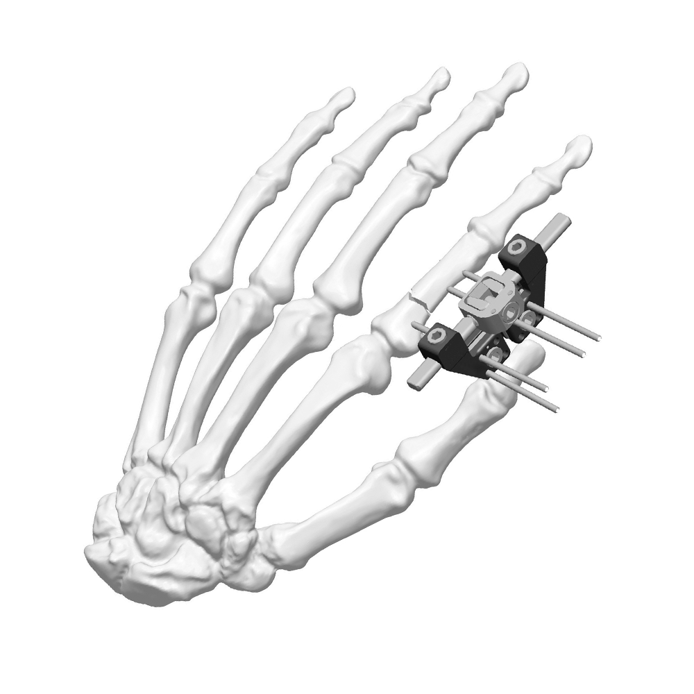 Mini External Fixator (L-type)