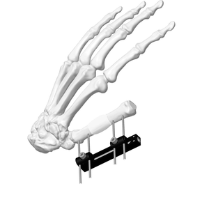 Mini External Fixator (Rail-type)