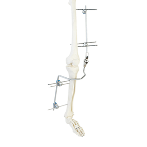 Knee External Fixator (Integrated)