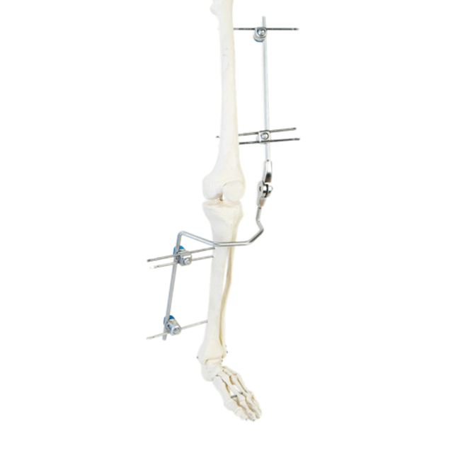 Knee External Fixator (Integrated)