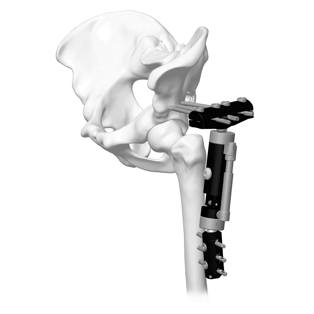 Lower Limb Micromotion External Fixator (Big T-type)