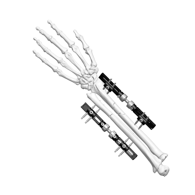 Wrist External Fixator (Tractive-type)