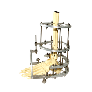 Ankle Fusion Ilizarov Fixator