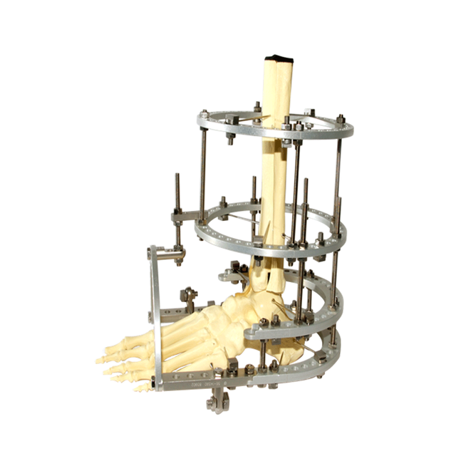 Ankle Fusion Ilizarov Fixator