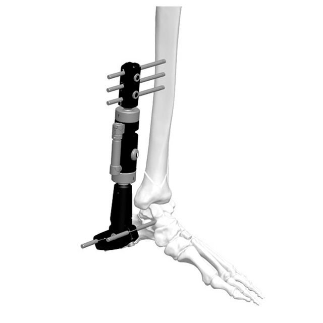 Lower Limb Micromotion External Fixator (Ankle T-type)
