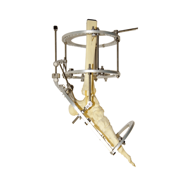 Equinus Ilizarov Fixator