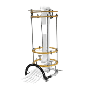 Tibia Transport Ilizarov Fixator