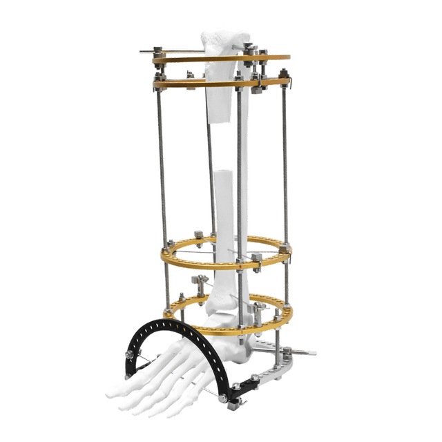 Tibia Transport Ilizarov Fixator