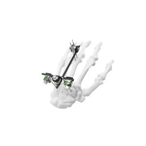 Mini External Fixator II