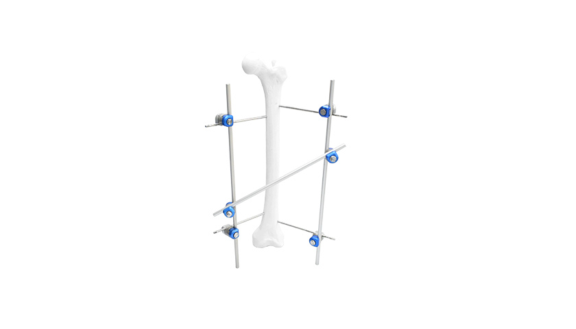 Femoral Shaft External Fixator Femoral Shaft External Fixator