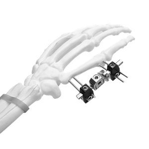 Mini External Fixator (Straight-type)