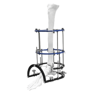 Ankle Fusion Ilizarov Fixator