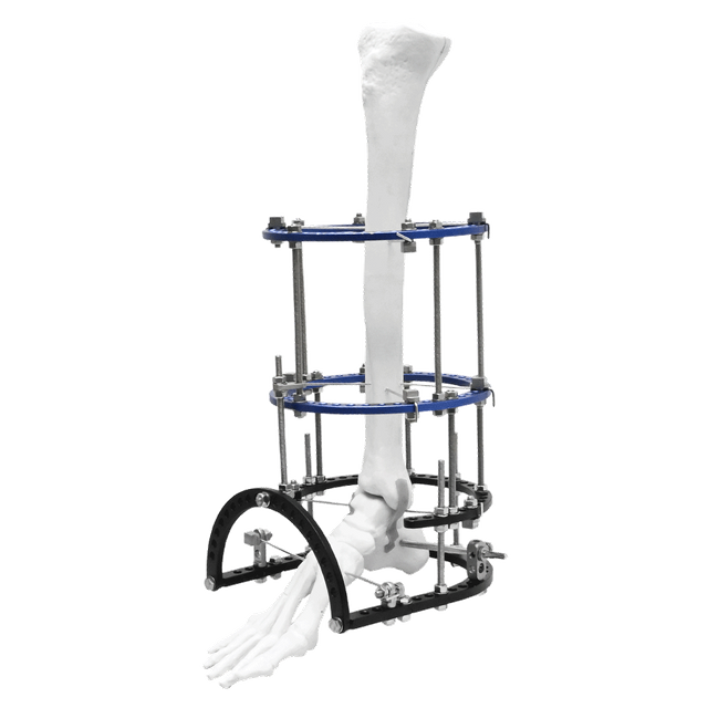 Ankle Fusion Ilizarov Fixator