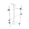Femoral Shaft External Fixator II