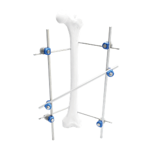 Femoral Shaft External Fixator II