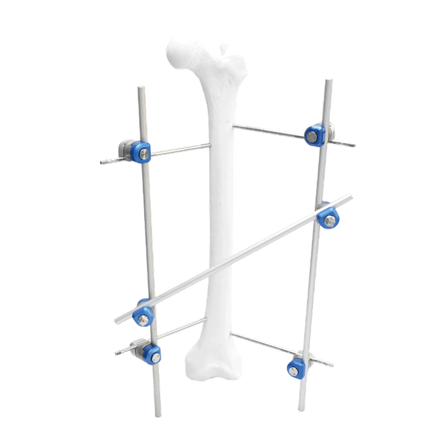 Femoral Shaft External Fixator II