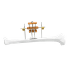 Tibia Transverse Bone Transport System