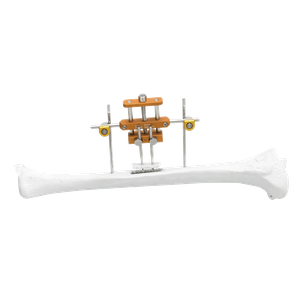 Tibia Transverse Bone Transport System
