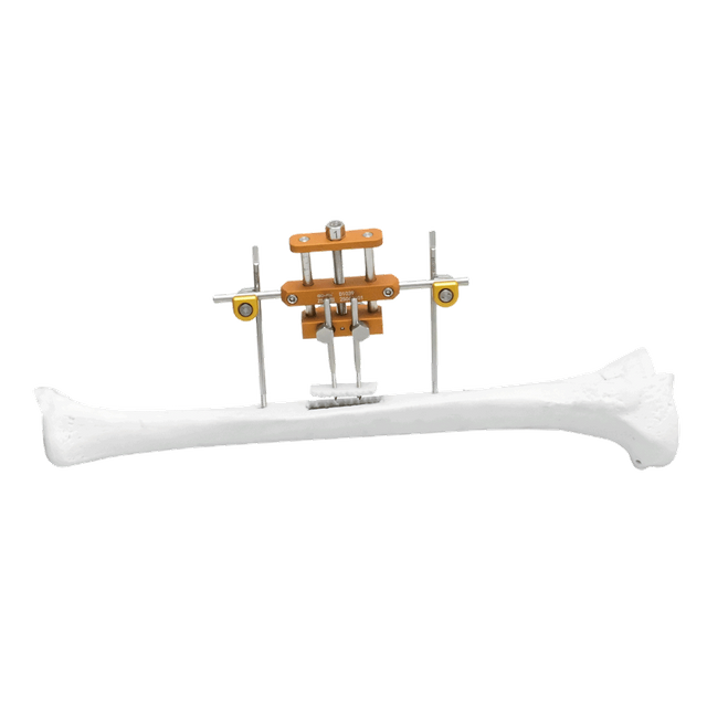 Tibia Transverse Bone Transport System