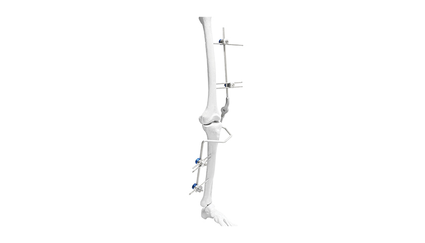 Knee-External-Fixator.jpg