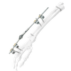 Wrist External Fixator (Integrated)