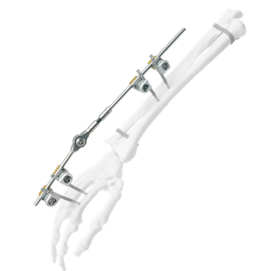 Wrist External Fixator (Integrated)