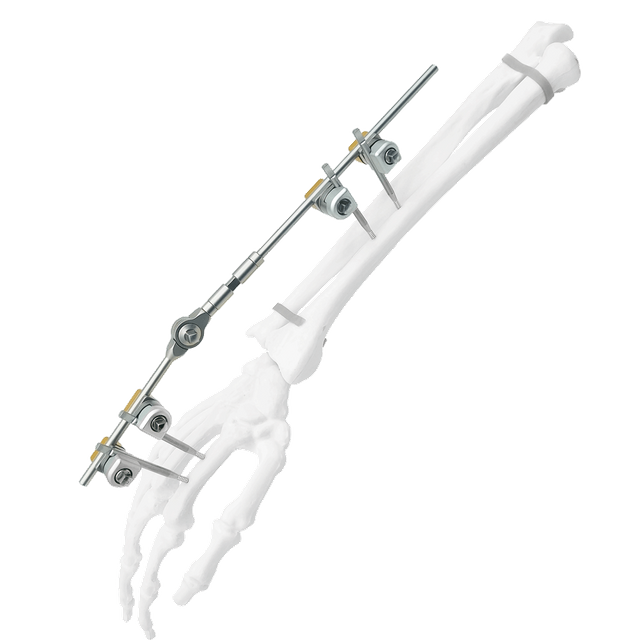 Wrist External Fixator (Integrated)