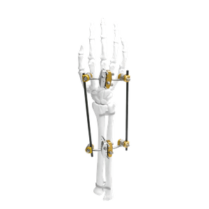 Ulna&Radius Spanning External Fixator