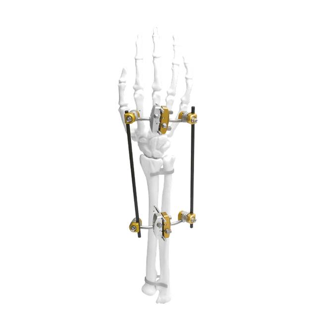 Ulna&Radius Spanning External Fixator