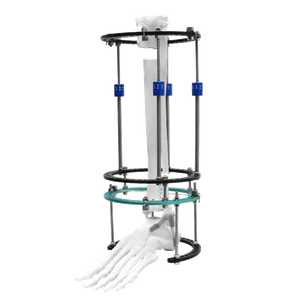 Tibial Lengthening Ilizarov Fixator