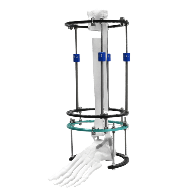 Tibial Lengthening Ilizarov Fixator
