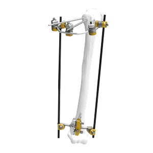 Proximal Humerus External Fixator