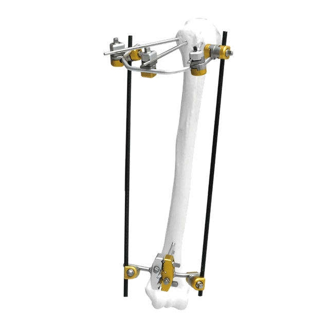 Proximal Humerus External Fixator