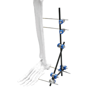 Ankle External Fixator