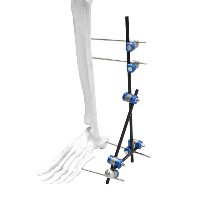 Ankle External Fixator