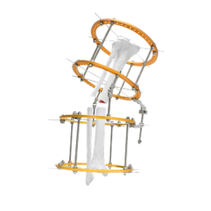 Vara Tibia Ilizarov Fixator