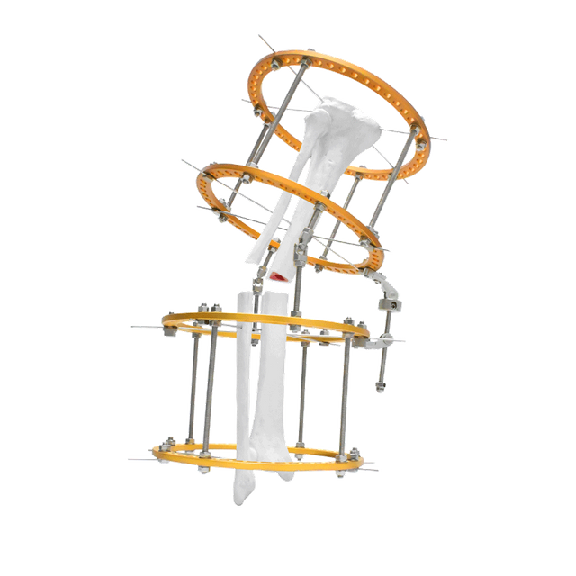 Vara Tibia Ilizarov Fixator