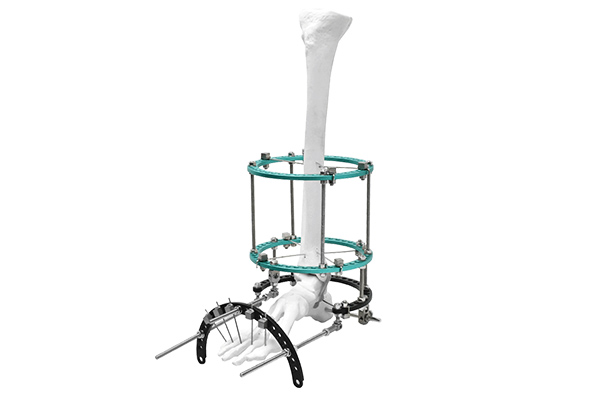 complex-foot-deformity-fixator complex-foot-deformity-fixator